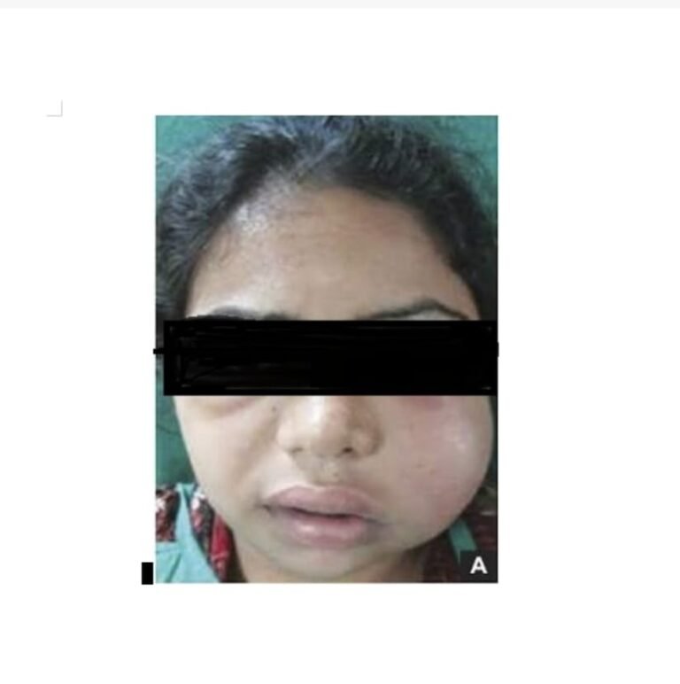 दांत की पुरानी सड़न से जबड़े में बनी थी बड़ी सिस्ट, आधुनिक तकनीक से बिना हड्डी को नुकसान पहुंचाए निकाला गया सिस्ट